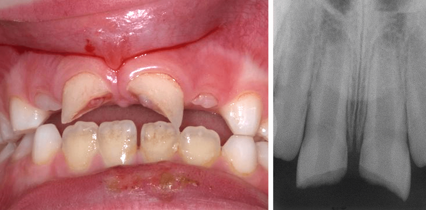 Die Möglichkeiten der konservativen endodontischen Therapie