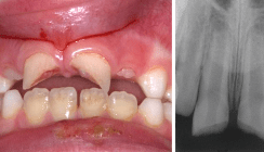 Die Möglichkeiten der konservativen endodontischen Therapie