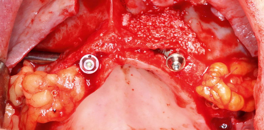 Insertion von Zygoma-Implantaten nach dem ZAGA-Konzept