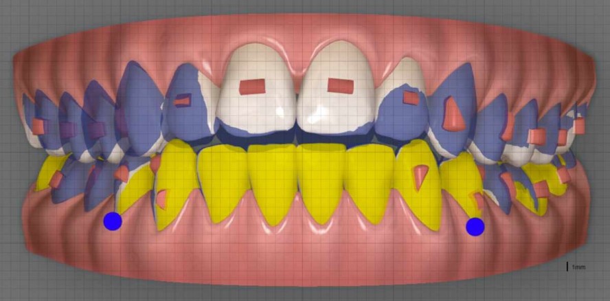 Protokoll für die digitale Alignerplanung bei frontal offenem Biss