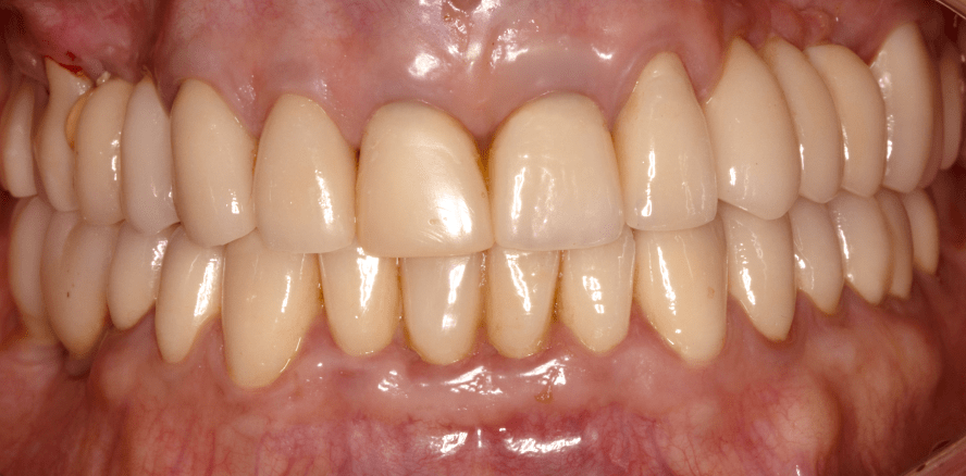 Digitale Präzision und Ästhetik – Sofortimplantation im Frontzahnbereich