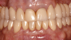 Digitale Präzision und Ästhetik – Sofortimplantation im Frontzahnbereich