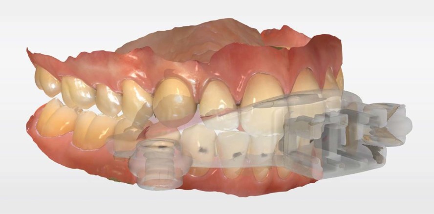 Digitale Schienenherstellung – Lohnend für Praxis und Praxislabor?