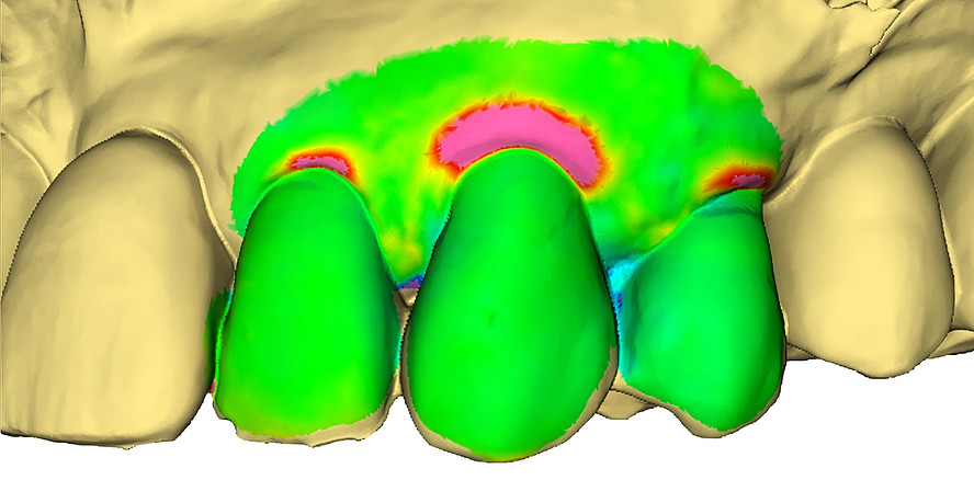 Zum digitalen Monitoring lokaler Parodontitis-Rezidive und gingivaler Rezessionen