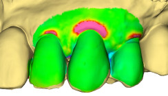 Zum digitalen Monitoring lokaler Parodontitis-Rezidive und gingivaler Rezessionen