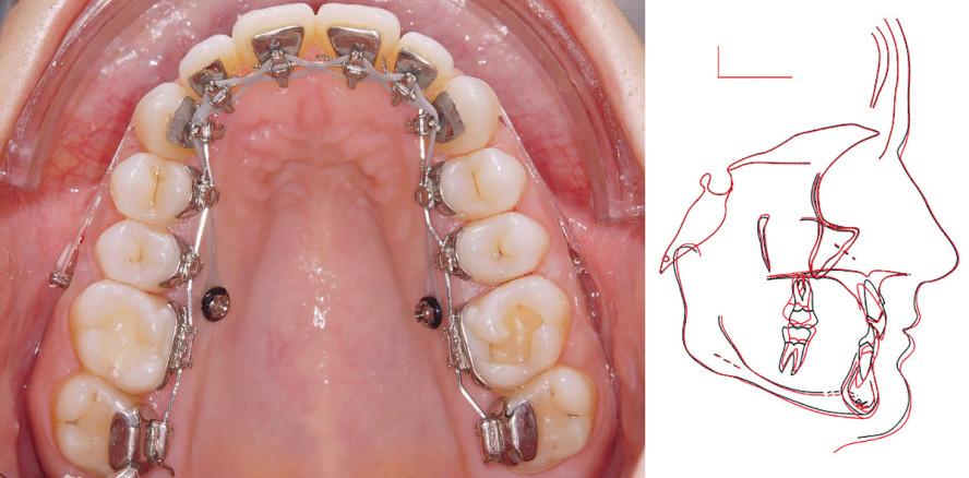 En-masse-Distalisation im Oberkiefer