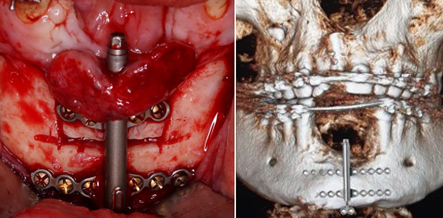 Distraktionsosteogenese im Unterkiefer