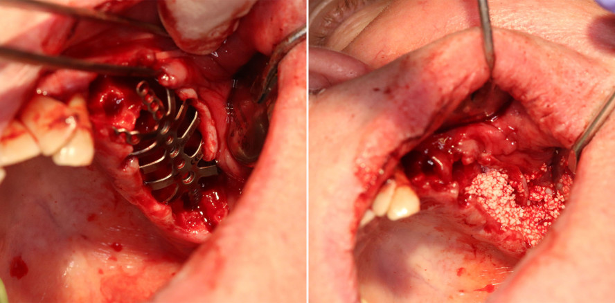 3D-Oberkieferrekonstruktion mit modifizierter Technik