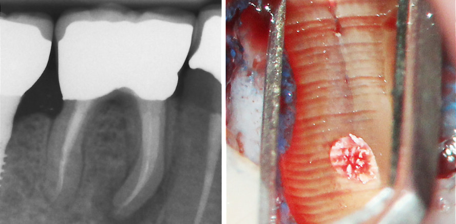 Anatomische Befunde bei der mikrochirurgischen WSR