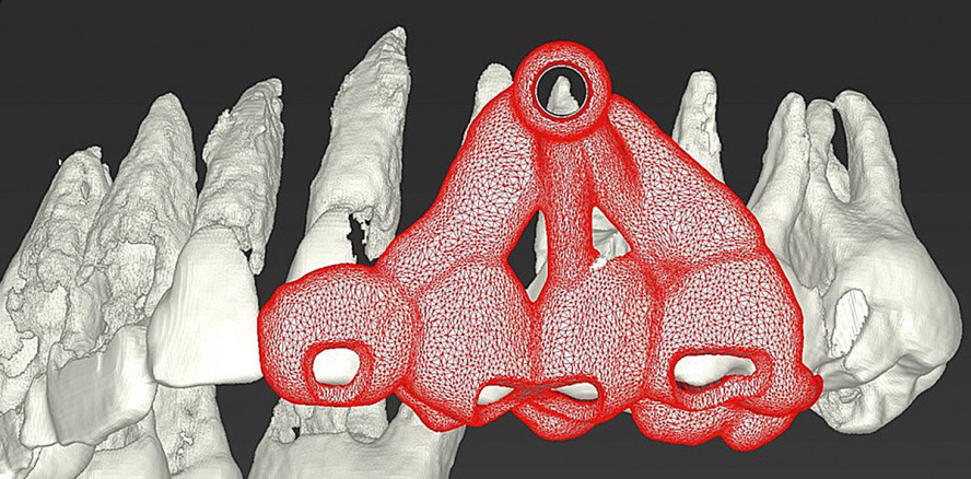 Minimalinvasive Easy-Guided Wurzelspitzenresektion