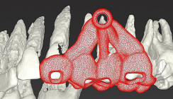 Minimalinvasive Easy-Guided Wurzelspitzenresektion