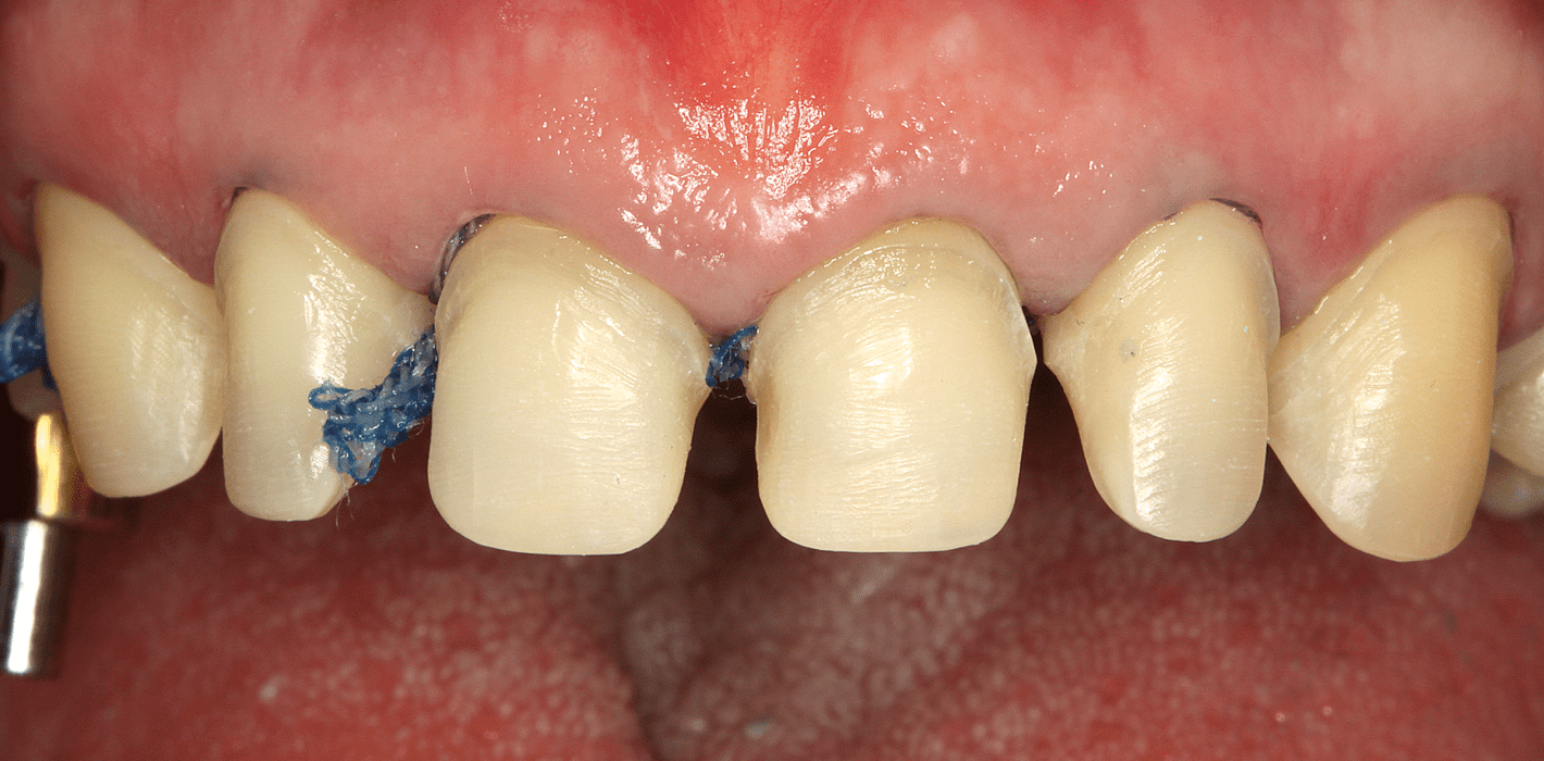 Vier-Quadranten-Rehabilitation einer stark erodierten Dentition