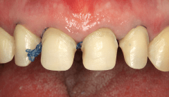 Vier-Quadranten-Rehabilitation einer stark erodierten Dentition