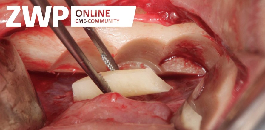 Eigenknochenaufbau im atrophierten Oberkiefer