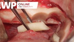 Eigenknochenaufbau im atrophierten Oberkiefer