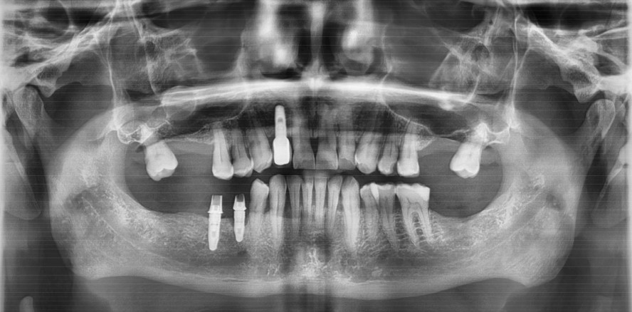 Einfluss der Recallfrequenz auf das Periimplantitisrisiko