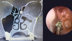 Einfluss von chronischer Sinusitis auf den Kiefer und Implantate
