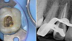 Endodontische Revisionsbehandlung: Wann, wie und mit welcher Prognose?