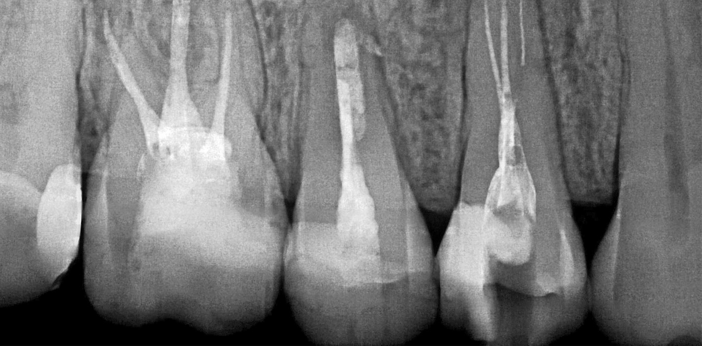 Endodontische Revision mit Bergung eines frakturierten Instruments