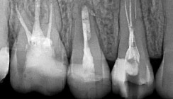 Endodontische Revision mit Bergung eines frakturierten Instruments