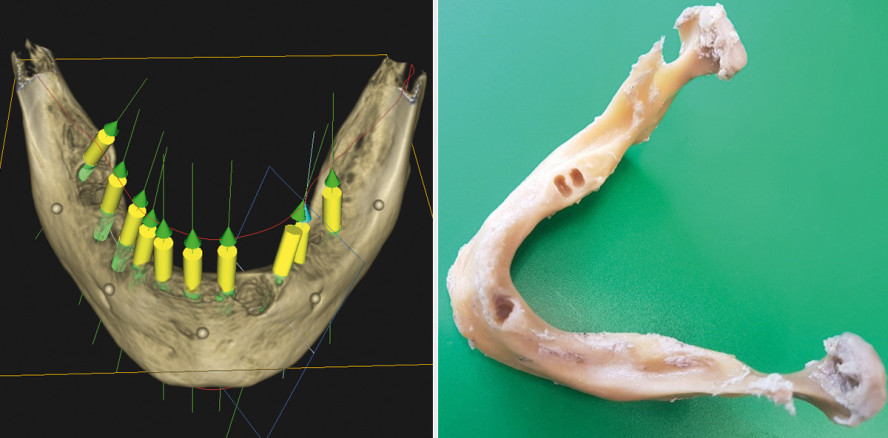 Entwicklung einer neuen Führungshülse aus Zirkoniumdioxid