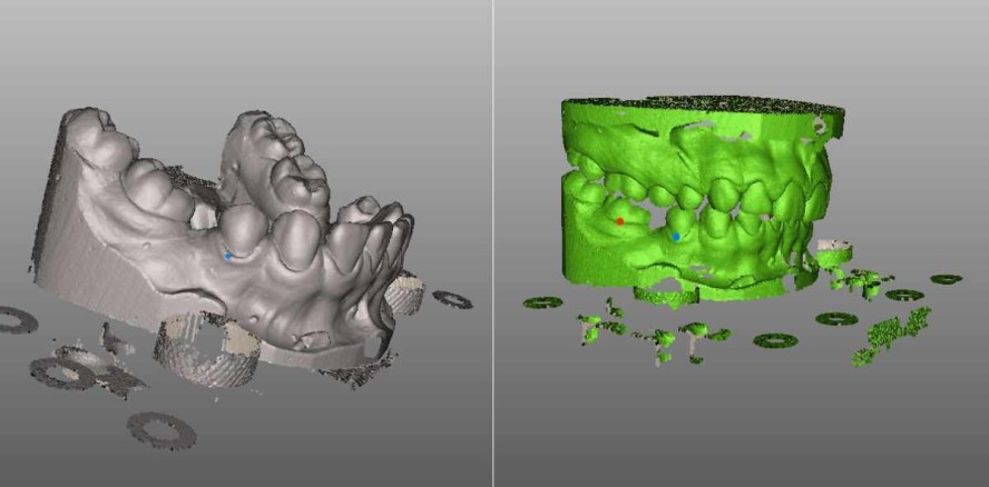 Die Ermittlung von IOTN und PAR-Index an digitalisierten Modellen