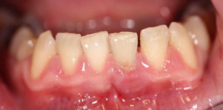 Zahnerhalt: Kombinierte endodontische Therapien