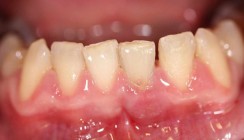 Zahnerhalt: Kombinierte endodontische Therapien