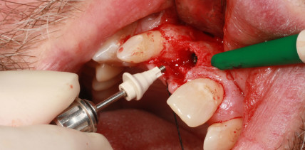 Verzögerte Sofortimplantation mit scanbarem Gingivaformer