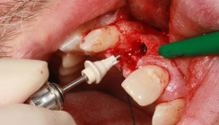Verzögerte Sofortimplantation mit scanbarem Gingivaformer