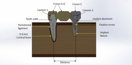 Minimum Implantation – Maximum Satisfaction