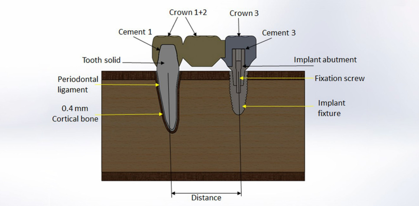 Minimum Implantation – Maximum Satisfaction