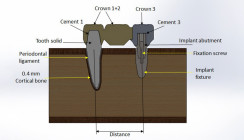 Minimum Implantation – Maximum Satisfaction