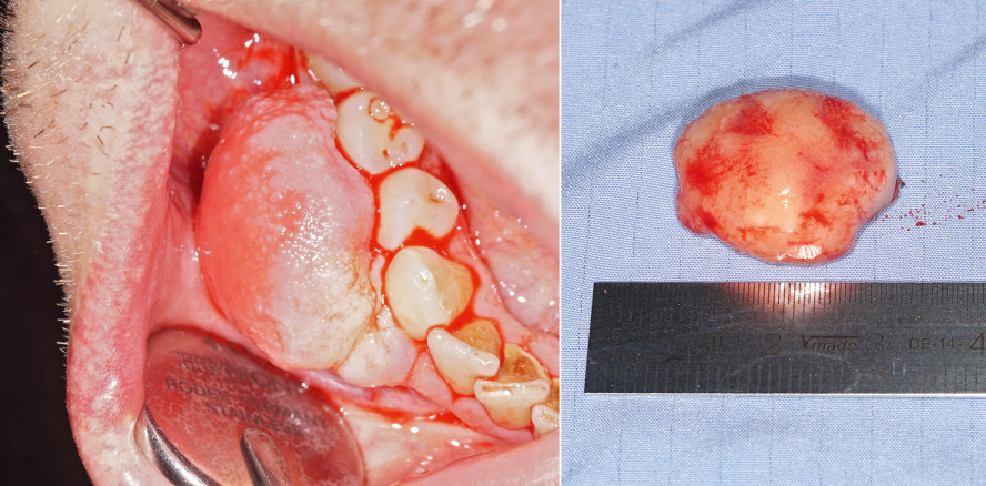 Entfernung eines peripheren odontogenen Fibroms