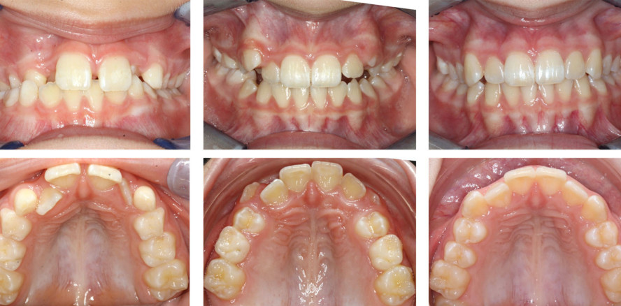 Frühbehandlung nach aktueller Vorgabe der S3-Leitlinie
