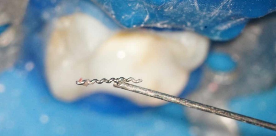 Fragmententfernung aus Wurzelkanälen – Teil 2