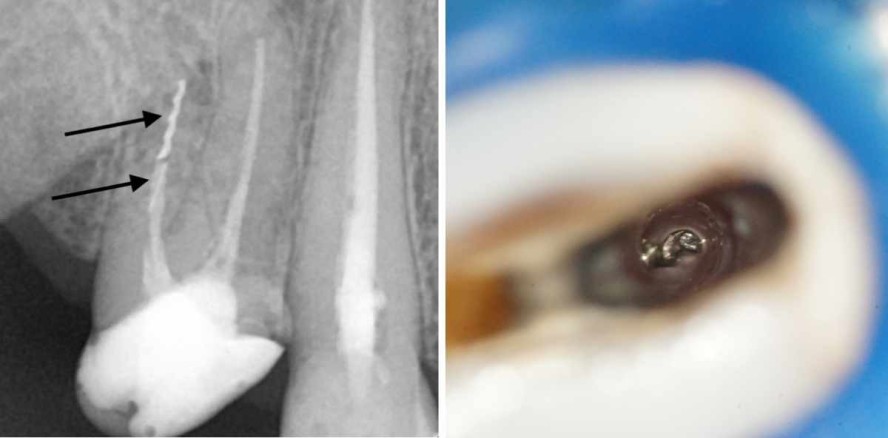 Fragmententfernung aus Wurzelkanälen – Teil 1: Überblick und Grundlagen