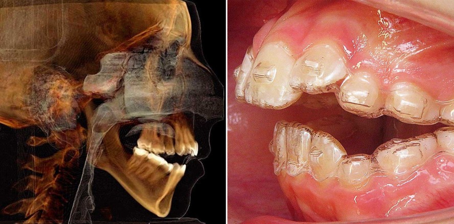 Frühbehandlung des offenen Bisses mittels Aligner-Therapie
