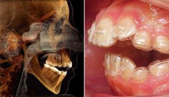 Frühbehandlung des offenen Bisses mittels Aligner-Therapie