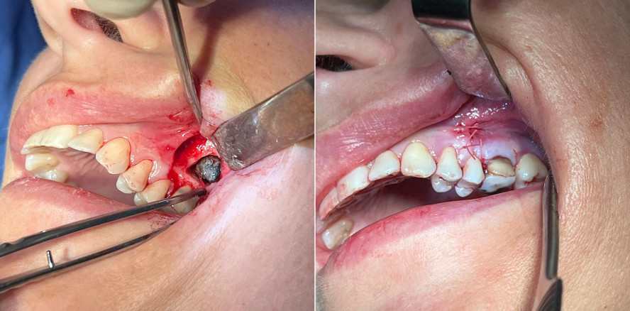 Fungusball in der Kieferhöhle nach Wurzelkanalbehandlung