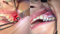 Fungusball in der Kieferhöhle nach Wurzelkanalbehandlung