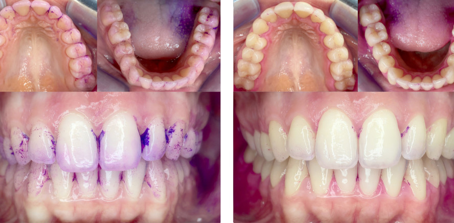 Vergleich: oszillierend-rotierende Zahnbürste vs. Schallzahnbürste