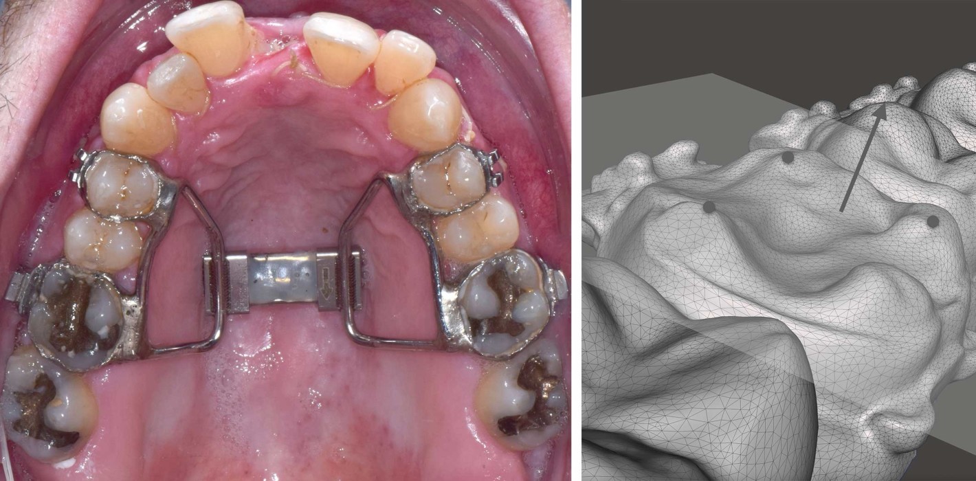 Gaumennahterweiterung vs. transversale dentoalveoläre Kompensation