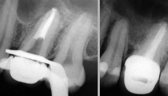 Möglichkeiten und Grenzen in der Endodontie