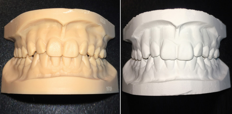 Digitale KFO: Gedruckte Modelle im Gutachterverfahren