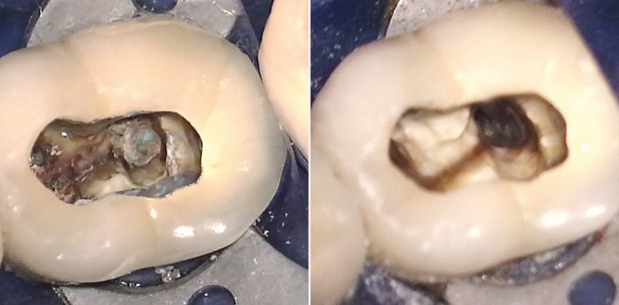 HEDP in der Endodontie – Neue Wege in der Wurzelkanaldesinfektion