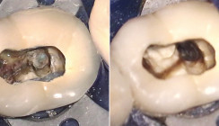 HEDP in der Endodontie – Neue Wege in der Wurzelkanaldesinfektion
