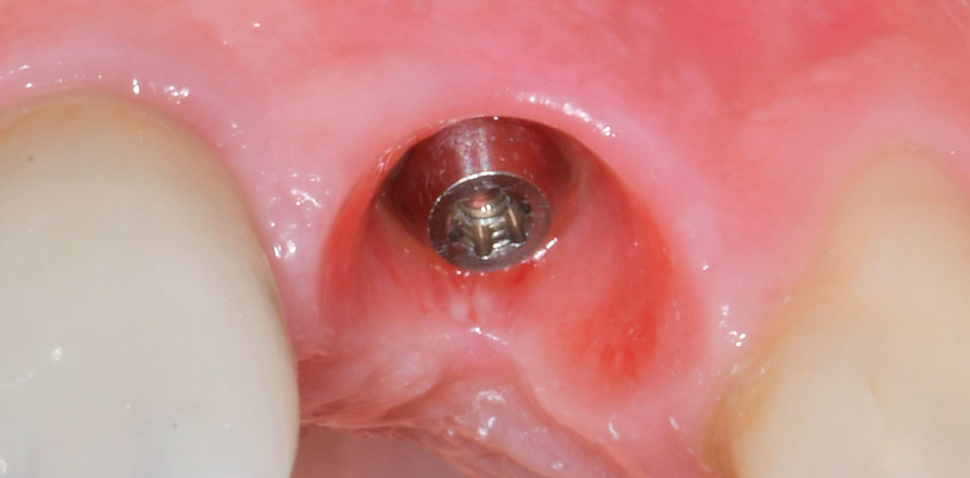 Die Herausforderung der periimplantären Infektion