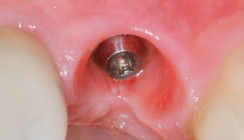 Die Herausforderung der periimplantären Infektion