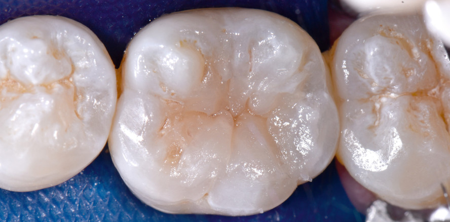 Hochleistungskomposit für die tägliche Arbeit